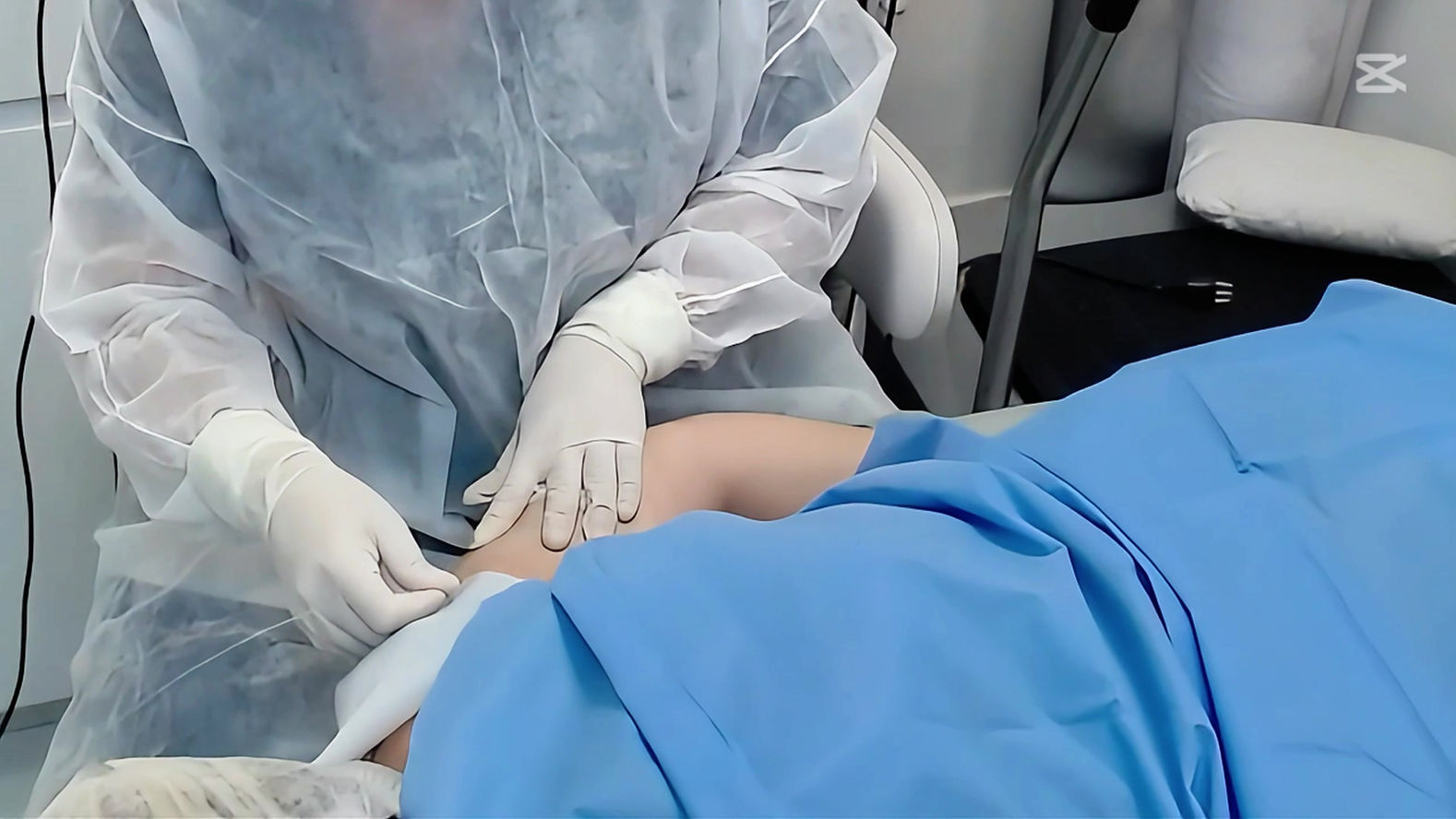 Tratamento de Flacidez nos braços com Endolift® / com Sedação Consciente com Óxido Nitroso